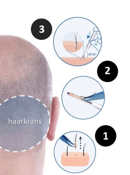 Hoe Werkt DHI Haartransplantatie?